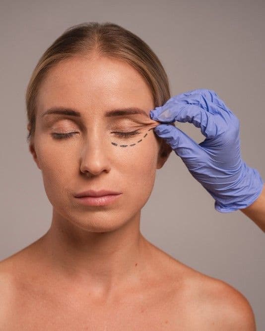 Blepharoplasty (Baggy Eyelids)