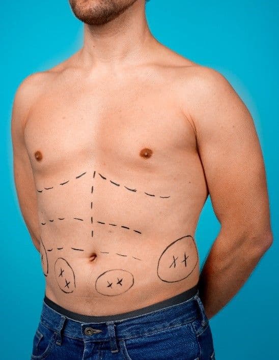 Abdominal Etching